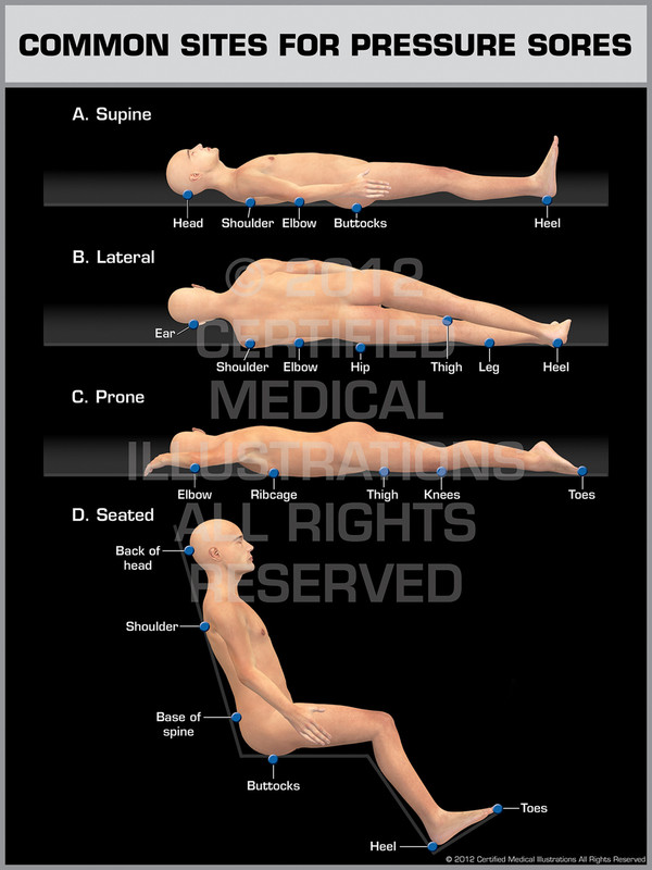 Exhibit of Common Sites For Pressure Sores.