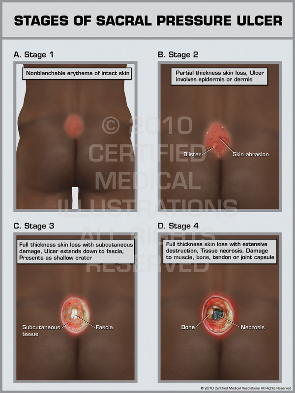 Exhibit of Stages of Sacral Pressure Ulcer.