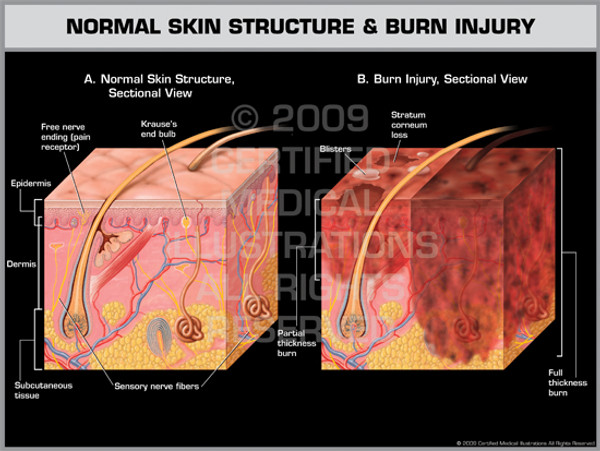 Exhibit of Normal Skin Structure & Burn Injury.