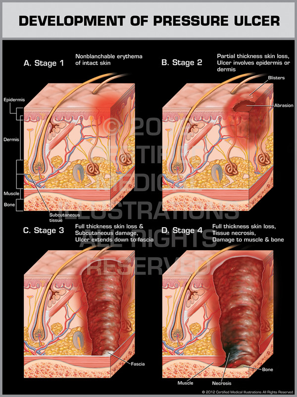 Exhibit of Development of Pressure Ulcer.