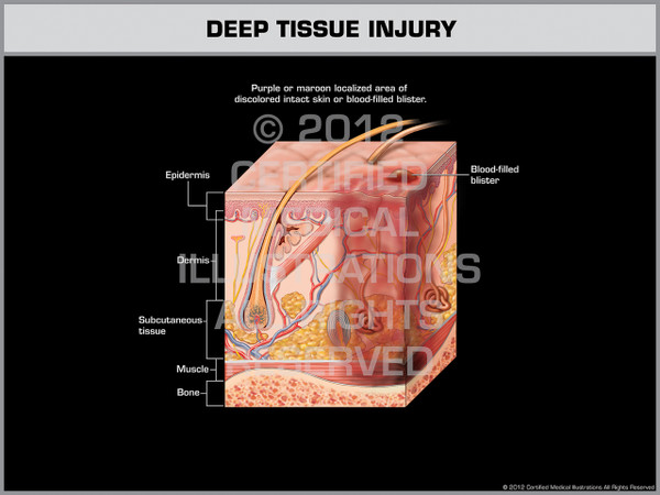 Exhibit of Deep Tissue Injury.