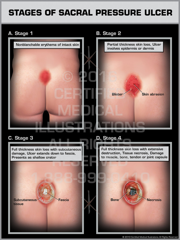 Exhibit of Stages of Sacral Pressure Ulcer I