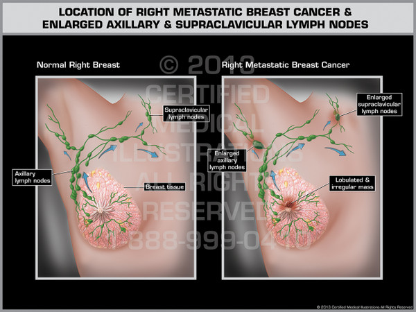Exhibit of Location of Right Metastatic Breast Cancer & Enlarged Axillary & Supraclavicular Lymph Nodes.