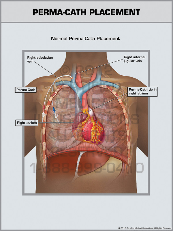 Exhibit of Perma-Cath Placement.