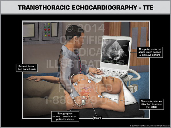 Exhibit of Transthoracic Echocardiography- TTE Male.