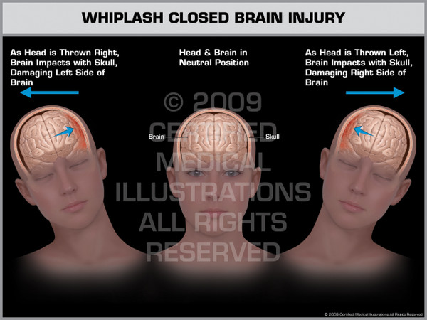 Exhibit of Whiplash Closed Brain Injury Female.