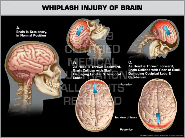 Exhibit of Whiplash Injury of Brain.