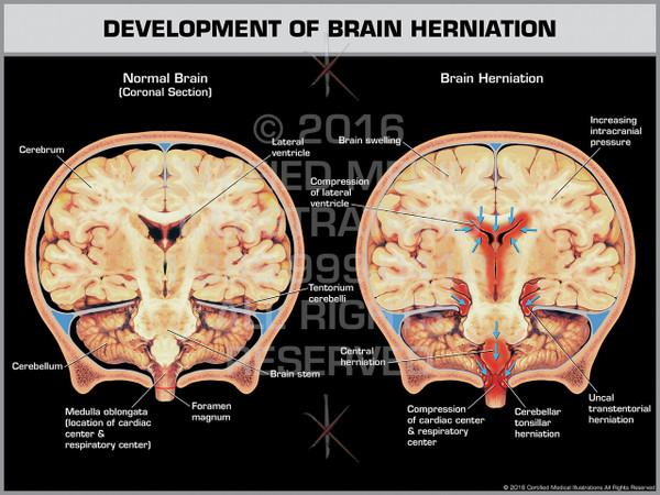 Exhibit of Development of Brain Herniation Coronal Section.