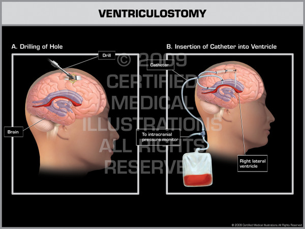 Exhibit of Ventriculostomy Female I.