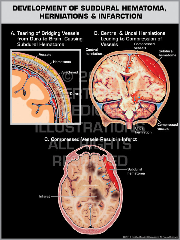 Exhibit of Development of Subdural Hematoma, Herniations & Infarction.
