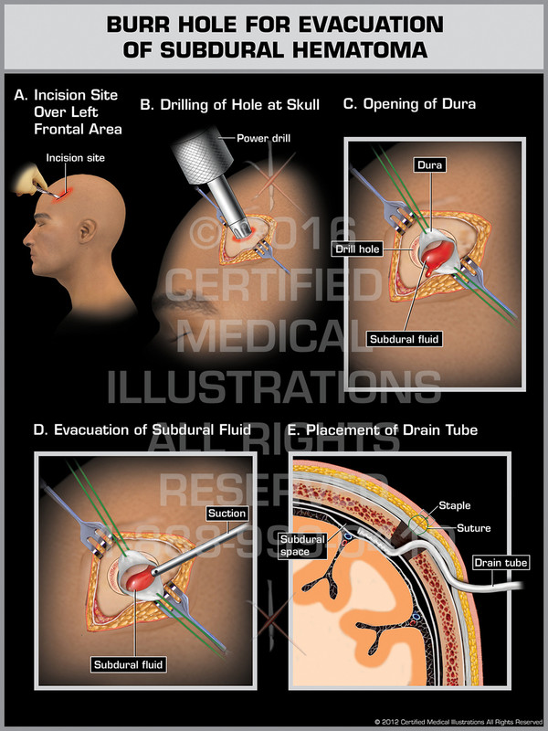 Exhibit of Burr Hole for Evacuation of Subdural Hematoma.