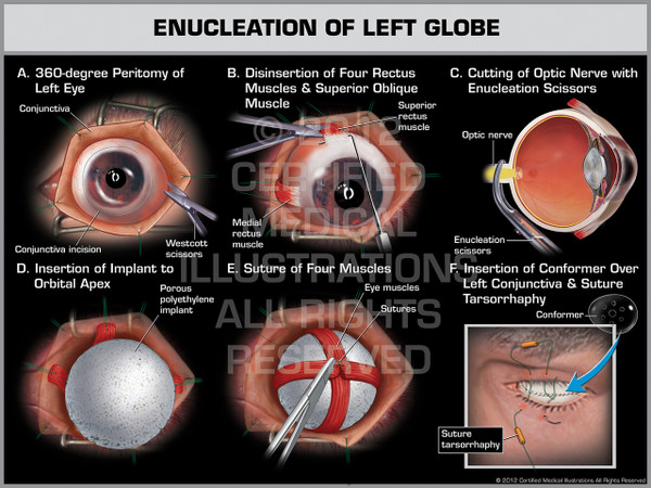 Exhibit of Enucleation of Left Globe.