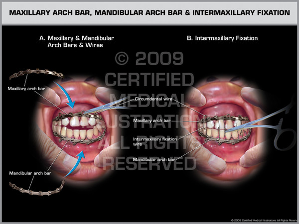 Exhibit of Maxillary Arch Bar, Mandibular Arch Bar and Intermaxillary Fixation.