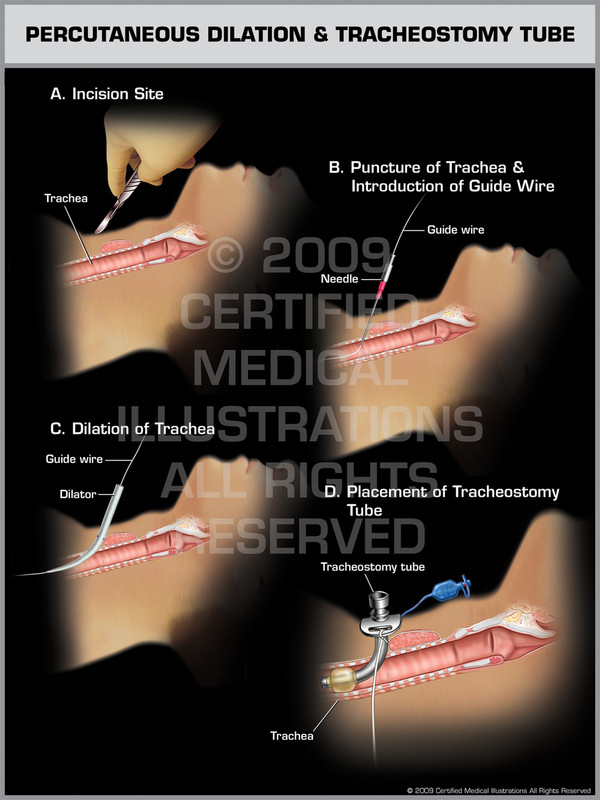 Exhibit of Percutaneous Dilation & Tracheostomy Tube.