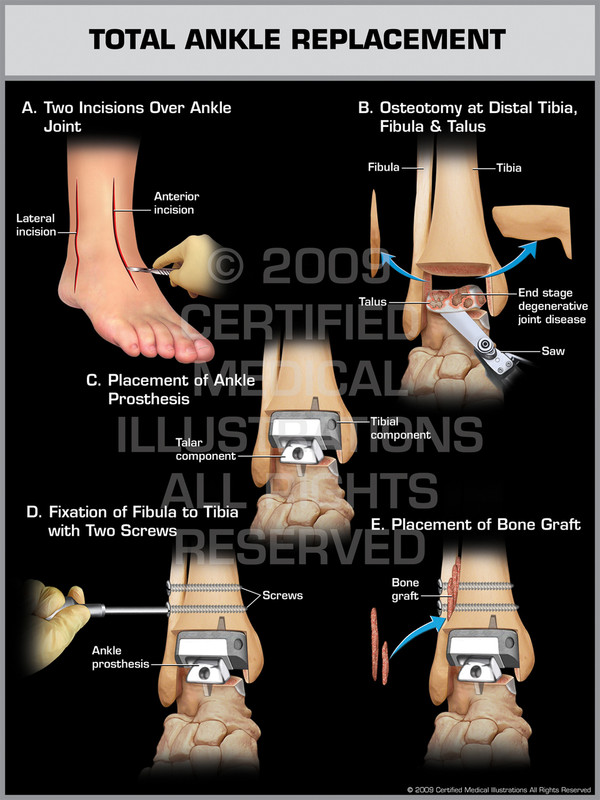 Exhibit of Total Ankle Replacement.