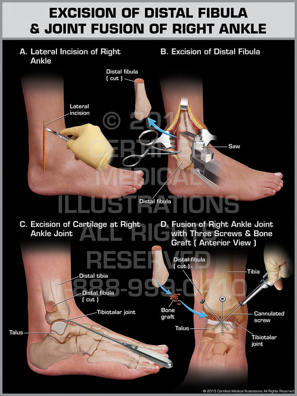 Exhibit of Excision of Distal Fibula & Joint Fusion of Right Ankle.