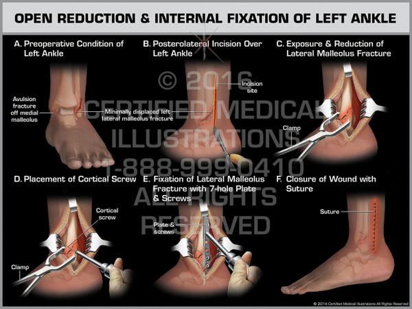 Exhibit of Open Reduction & Internal Fixation of Left Ankle.