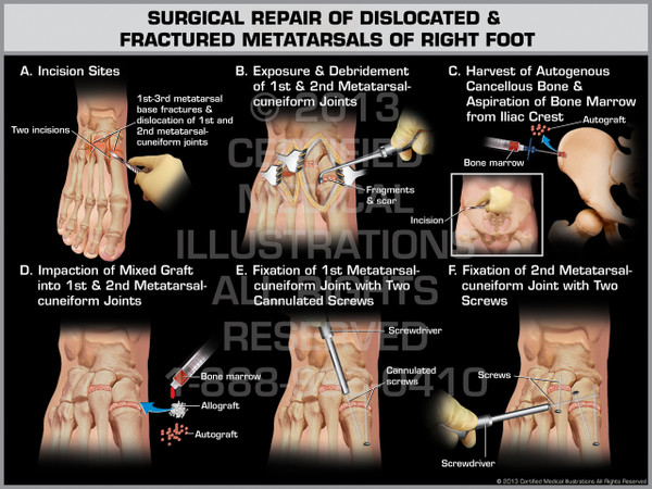 Exhibit of Surgical Repair of Dislocated & Fractured Metatarsals of Right Foot.