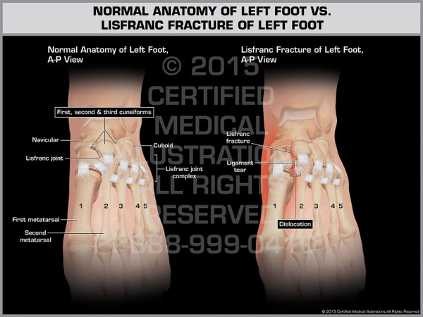 Exhibit of Normal Anatomy of Left Foot vs. Lisfranc Fracture of Left Foot.