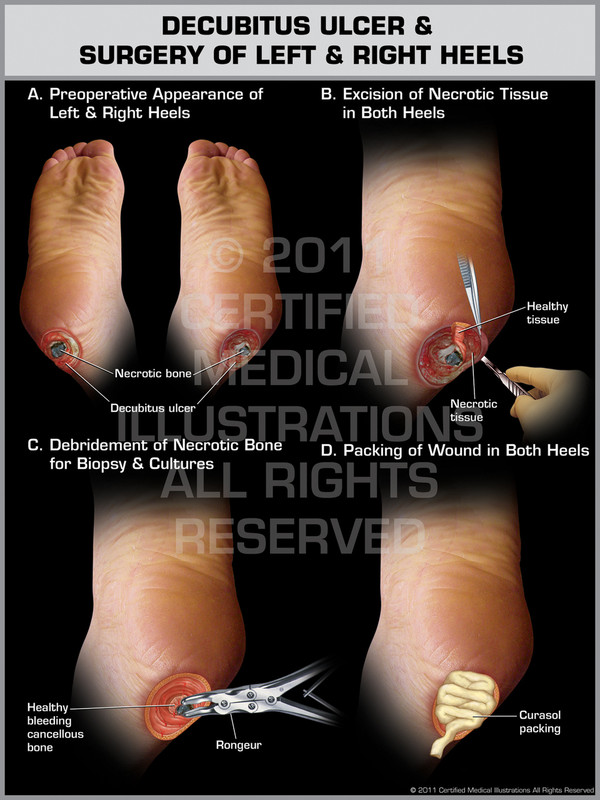 Exhibit of Decubitus Ulcer & Surgery of Left & Right Heels.