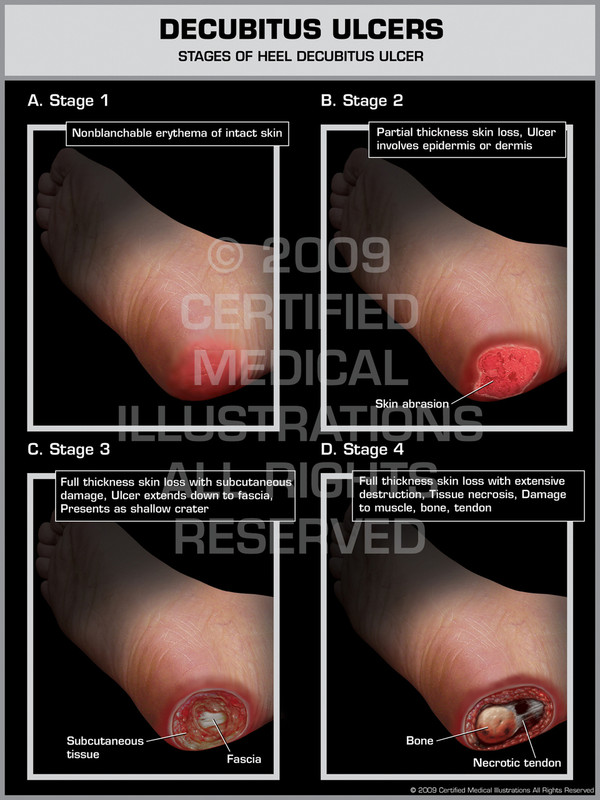 Exhibit of Decubitus Ulcers - Stages of Heel Decubitus Ulcer.