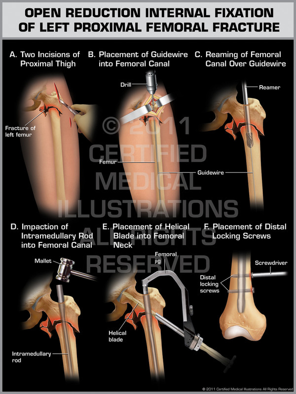 Exhibit of Open Reduction Internal Fixation of Left Proximal Femoral Fracture.