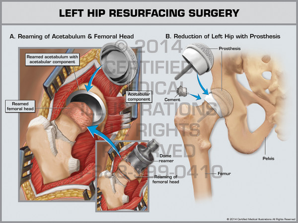 Exhibit of Left Hip Resurfacing Surgery.