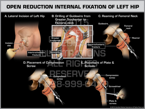 Exhibit of Open Reduction Internal Fixation of Left Hip.