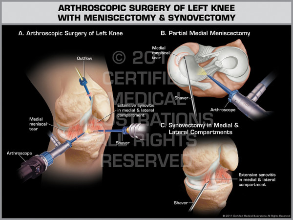 Exhibit of Arthroscopic Surgery of Left Knee with Meniscectomy & Synovectomy.