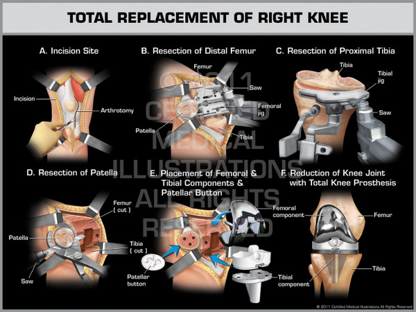 Exhibit of Total Replacement of Right Knee.