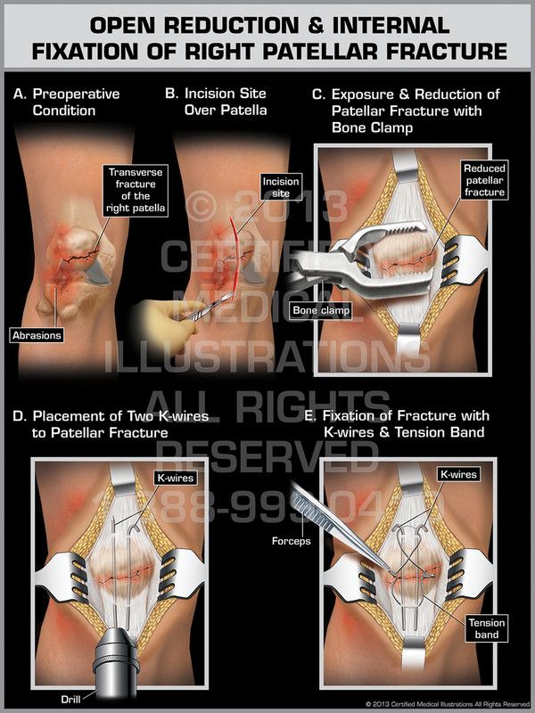Exhibit of Open Reduction & Internal Fixation of Right Patellar Fracture.