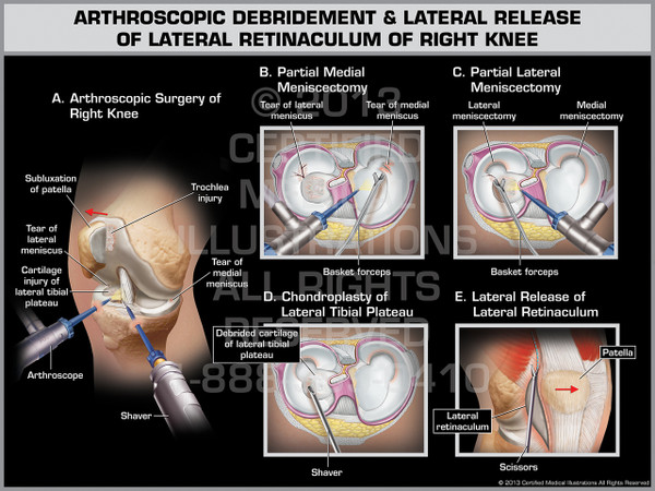 Exhibit of Arthroscopic Debridement & Lateral Release of Lateral Retinaculum of Right Knee.