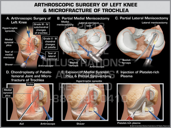 Exhibit of Arthroscopic Surgery of Left Knee & Microfracture of Trochlea.
