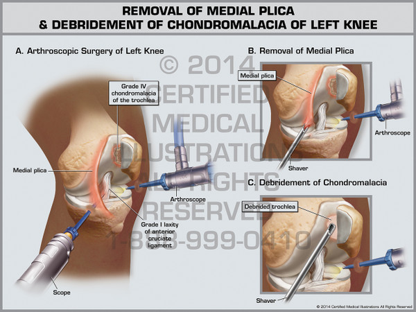 Exhibit of Removal of Medial Plica & Debridement of Chondromalacia of Left Knee.