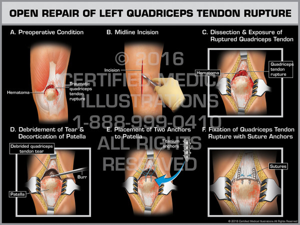 Open Repair of Left Quadriceps Tendon Rupture