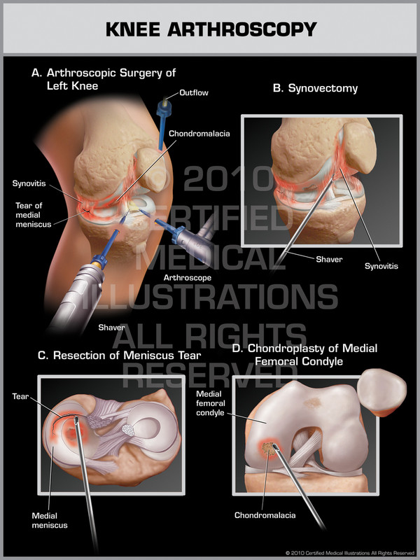Knee Arthroscopy Knee Arthroscopy