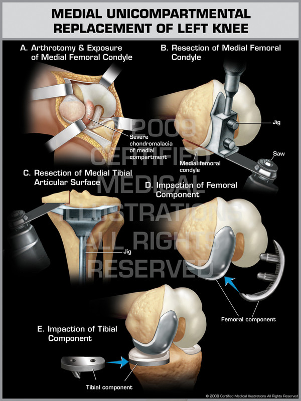 Medial Unicompartmental Replacement of Left Knee