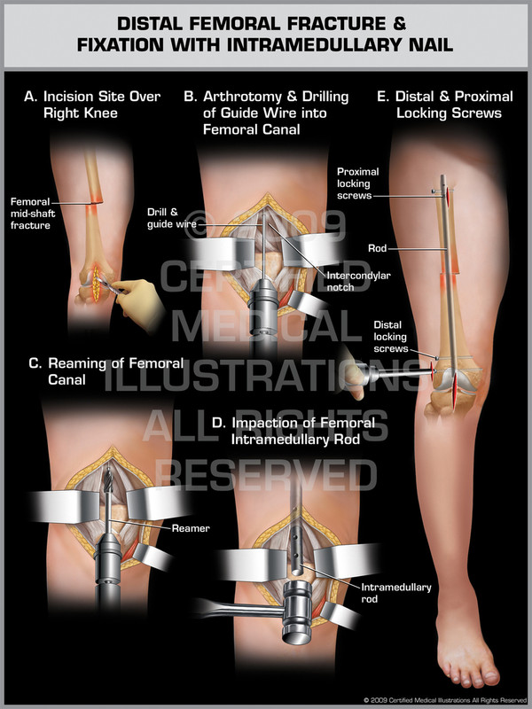 Exhibit of Distal Femoral Fracture & Fixation with Intramedullary Nail.