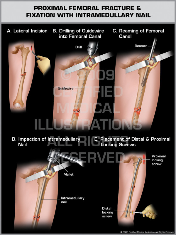 Exhibit of Proximal Femoral Fracture & Fixation with Intramedullary Nail.