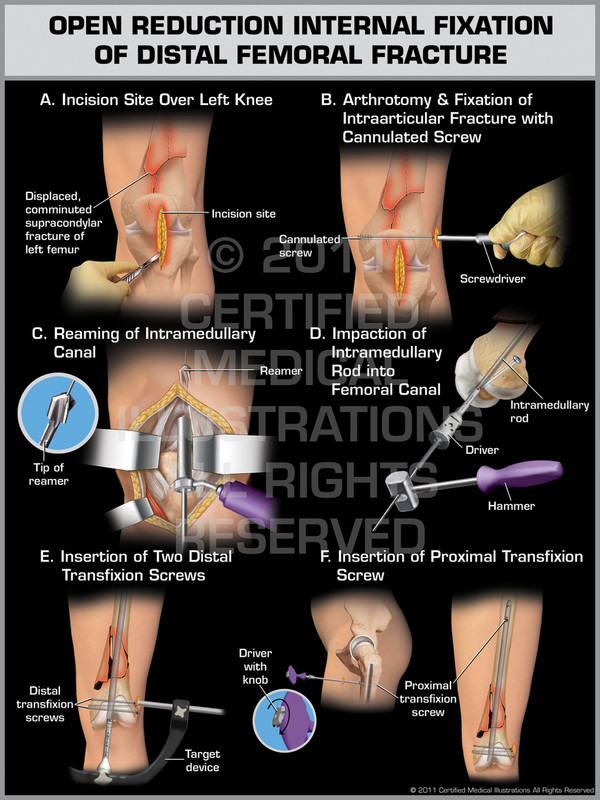 Exhibit of Open Reduction Internal Fixation of Distal Femoral Fracture.