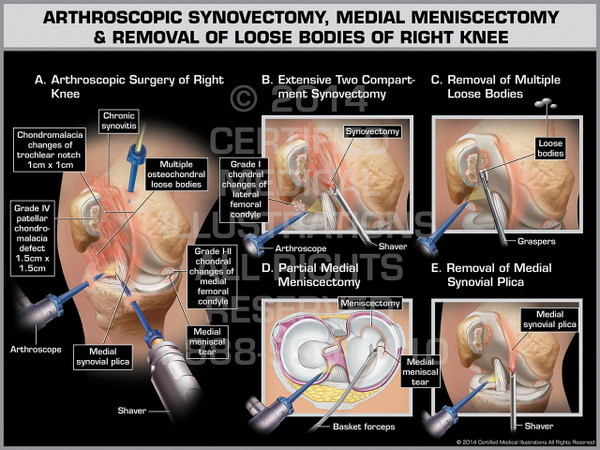 Exhibit of Arthroscopic Synovectomy, Medial Meniscectomy & Removal of Loose Bodies of Right Knee.