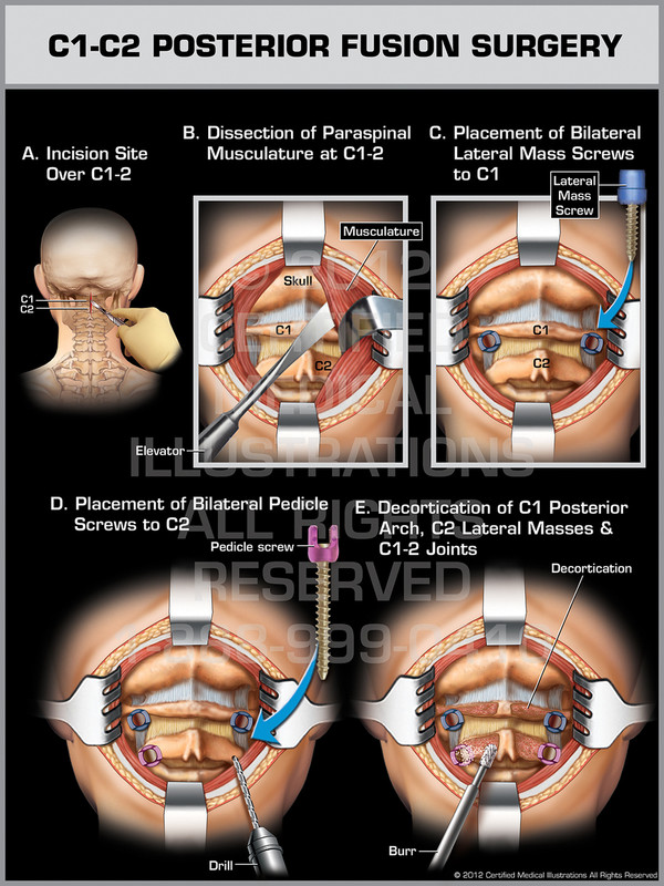 Exhibit of C1-C2 Posterior Fusion Surgery.