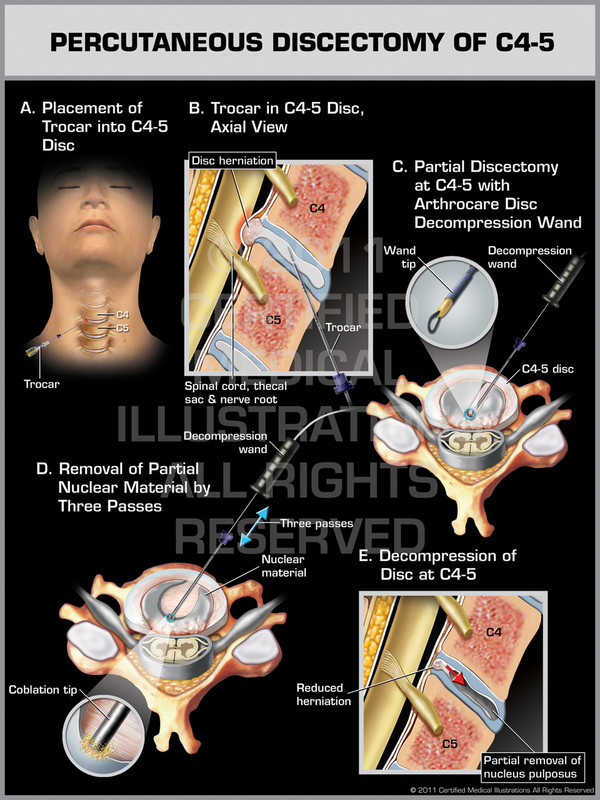 Exhibit of Percutaneous Discectomy of C4-5.