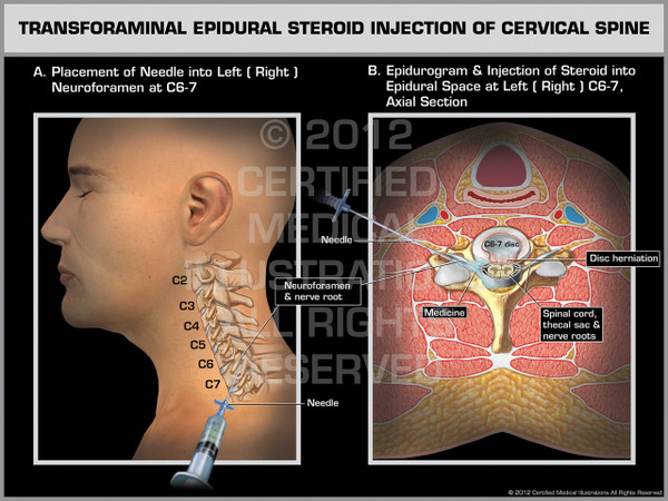 Exhibit of Transforaminal Epidural Steroid Injection of Cervical Spine Male.