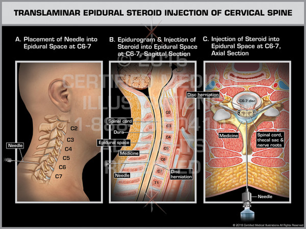 Exhibit of Translaminar Epidural Steroid Injection of Cervical Spine Male.