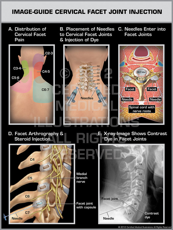 Exhibit of Image-Guide Cervical Facet Joint Injection Male.