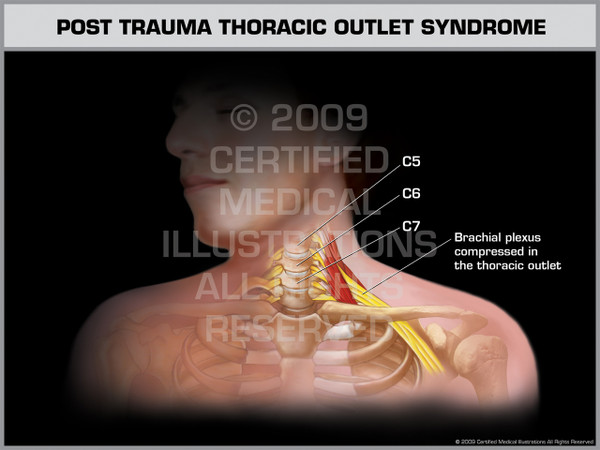 Exhibit of Post Trauma Thoracic Outlet Syndrome Male.