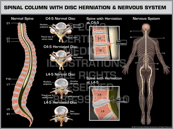 Exhibit of Spinal Column with Disc Herniation & Nervous System.