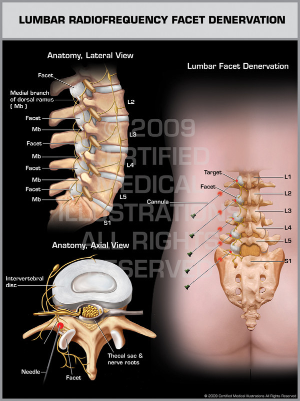 Exhibit of Lumbar Radiofrequency Facet Denervation.
