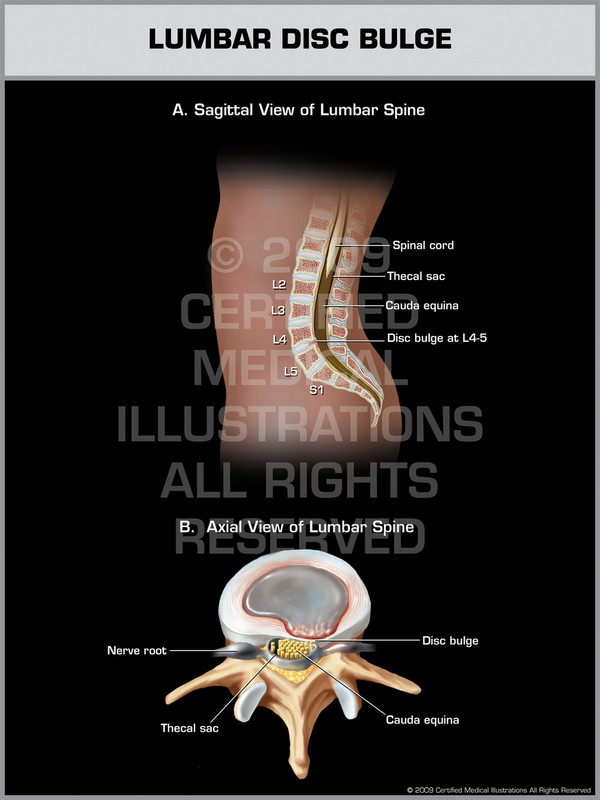 Exhibit of Lumbar Disc Bulge.